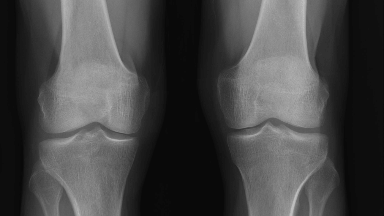 Normal Knee Xray